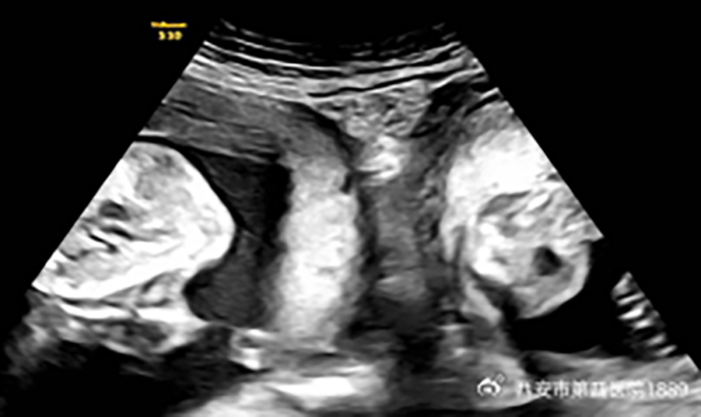 Woman with rare double uterus gives birth to twins
